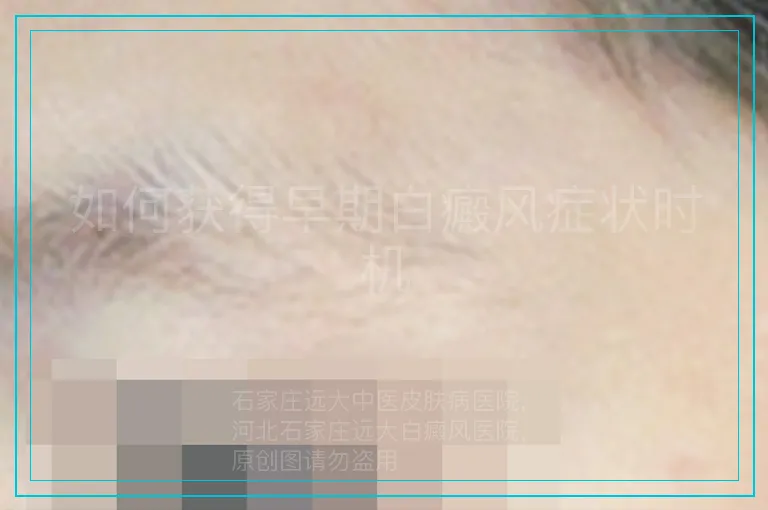 如何获得早期白癜风症状时机