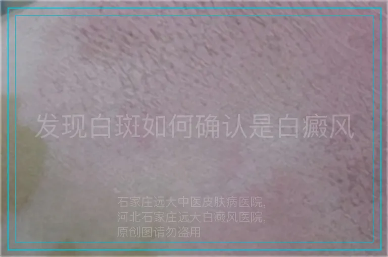 发现白斑如何确认是白癜风