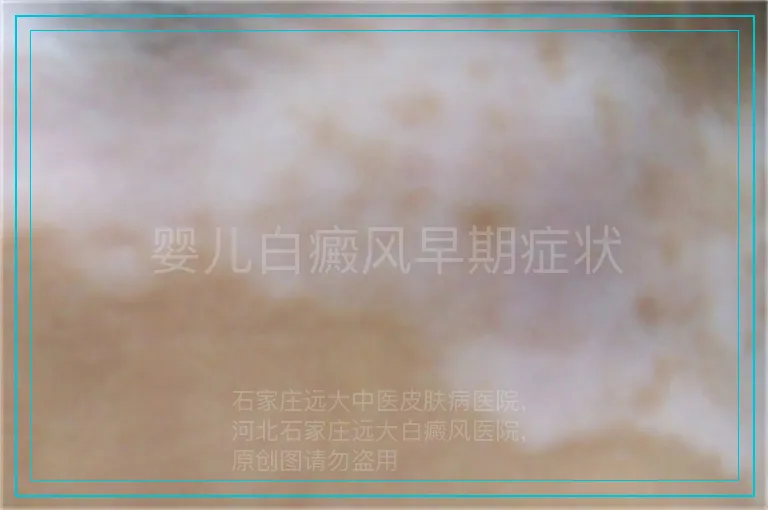 婴儿白癜风早期症状