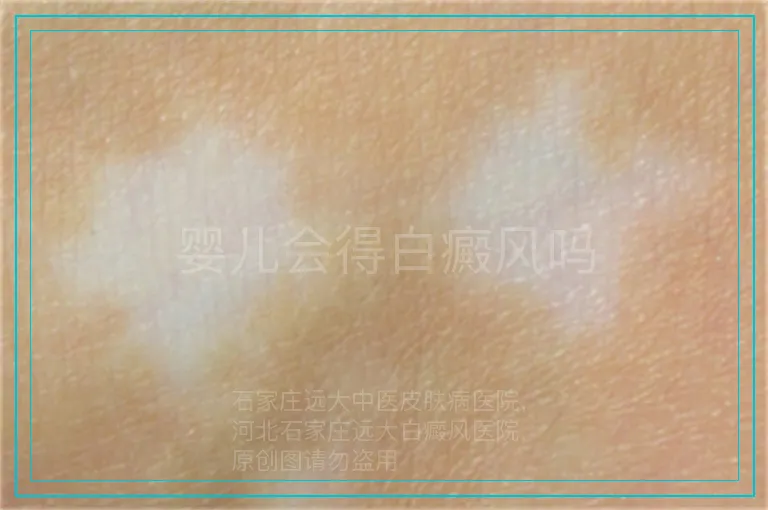 婴儿会得白癜风吗