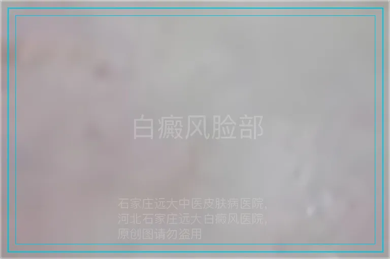 白癜风脸部