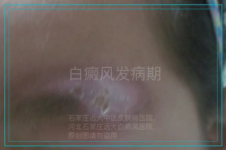 白癜风发病期