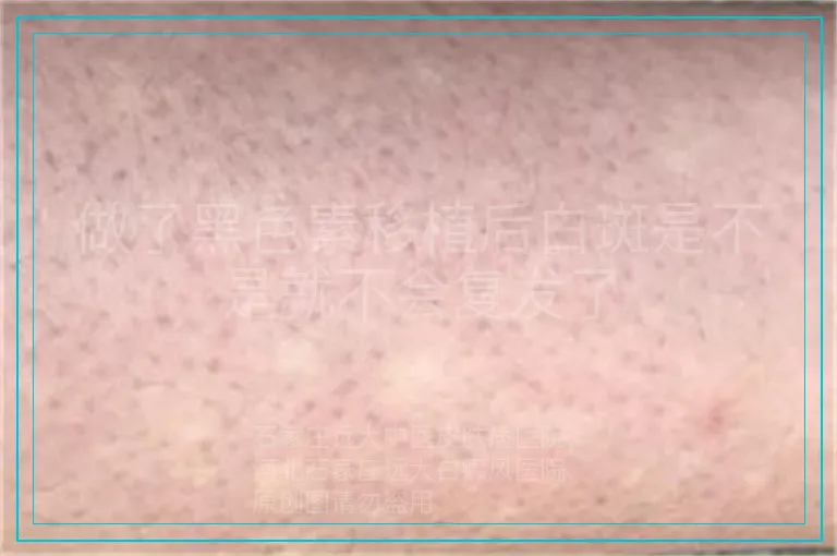 做了黑色素移植后白斑是不是就不会复发了