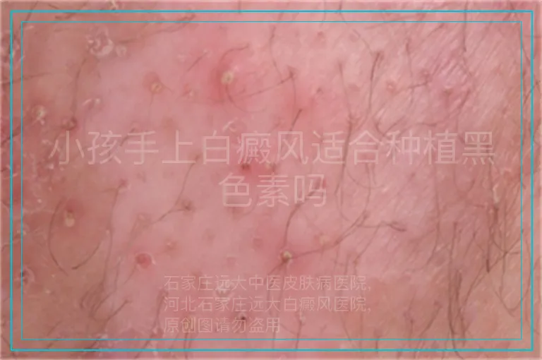 小孩手上白癜风适合种植黑色素吗
