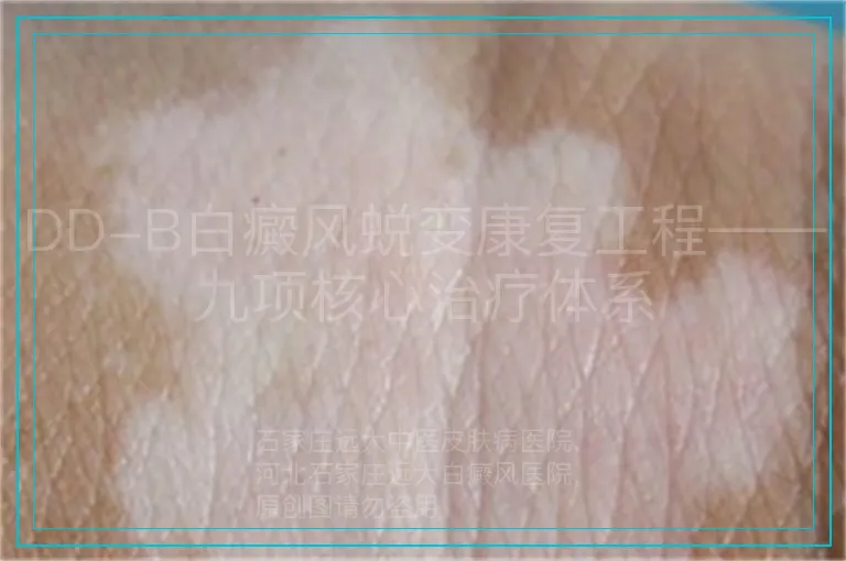 DD-B白癜风蜕变康复工程——九项核心治疗体系