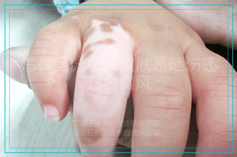 怎样区分小孩皮肤是晒伤还是白癜风