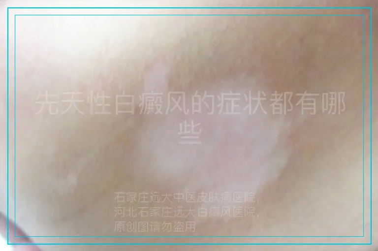 先天性白癜风的症状都有哪些