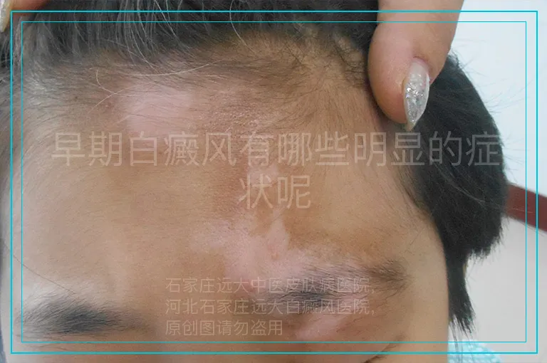 早期白癜风有哪些明显的症状呢