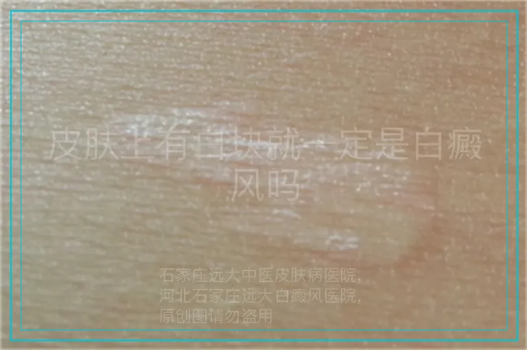 皮肤上有白块就一定是白癜风吗