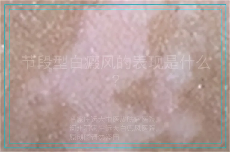 节段型白癜风的表现是什么?