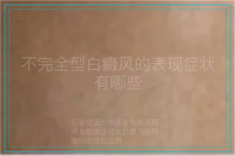 不完全型白癜风的表现症状有哪些