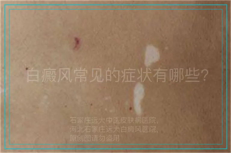 白癜风常见的症状有哪些?