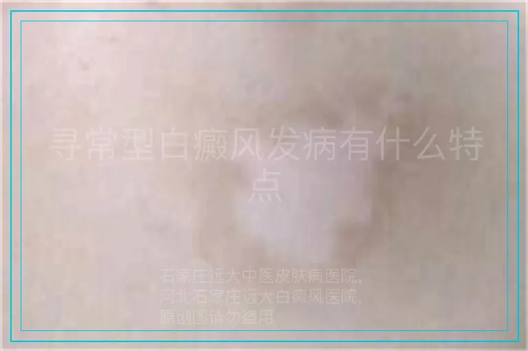 寻常型白癜风发病有什么特点