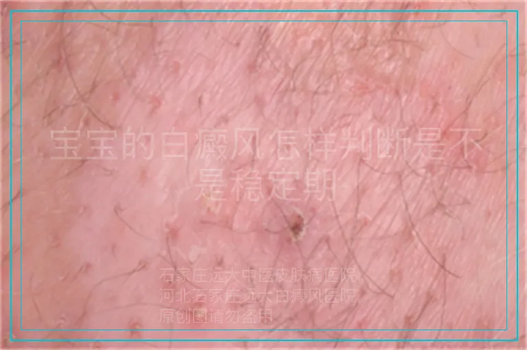 宝宝的白癜风怎样判断是不是稳定期