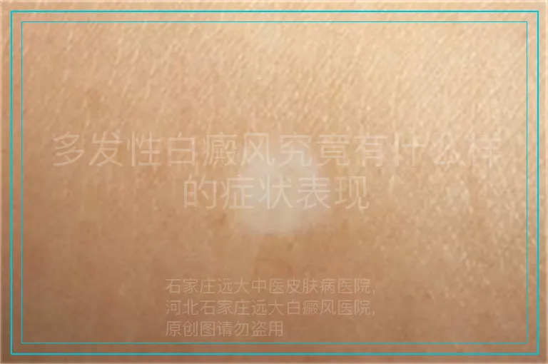 多发性白癜风究竟有什么样的症状表现