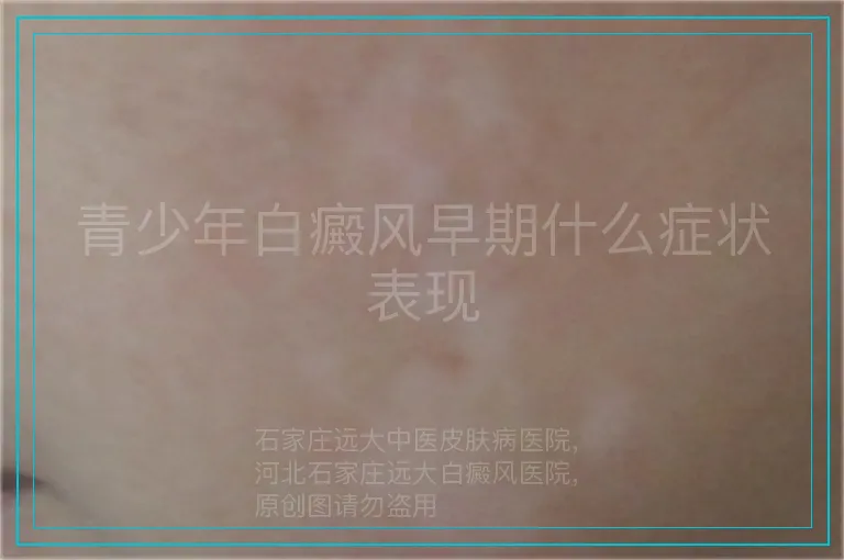 青少年白癜风早期什么症状表现