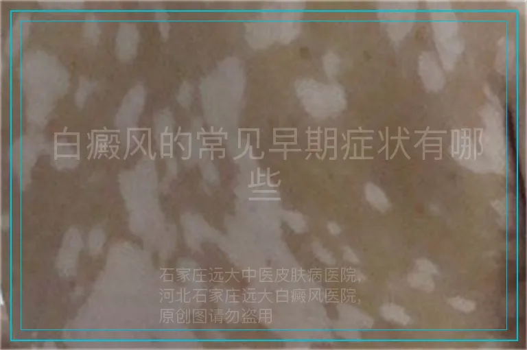 白癜风的常见早期症状有哪些