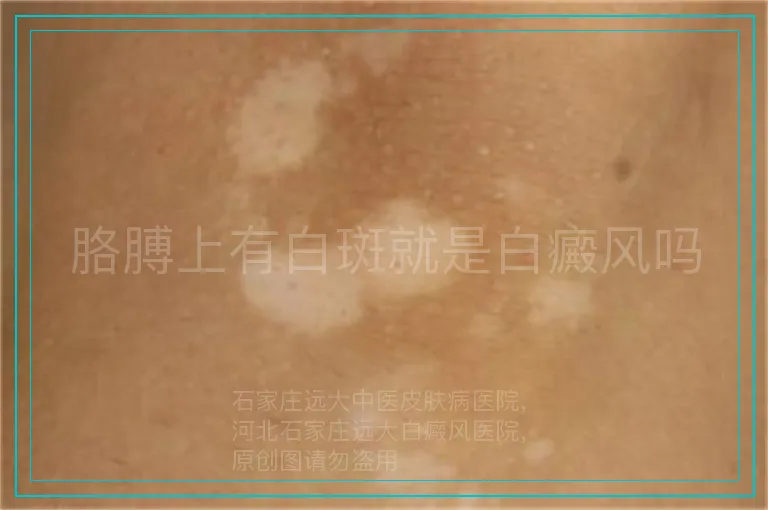 胳膊上有白斑就是白癜风吗