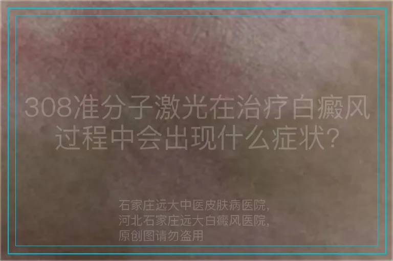 308准分子激光在治疗白癜风过程中会出现什么症状?