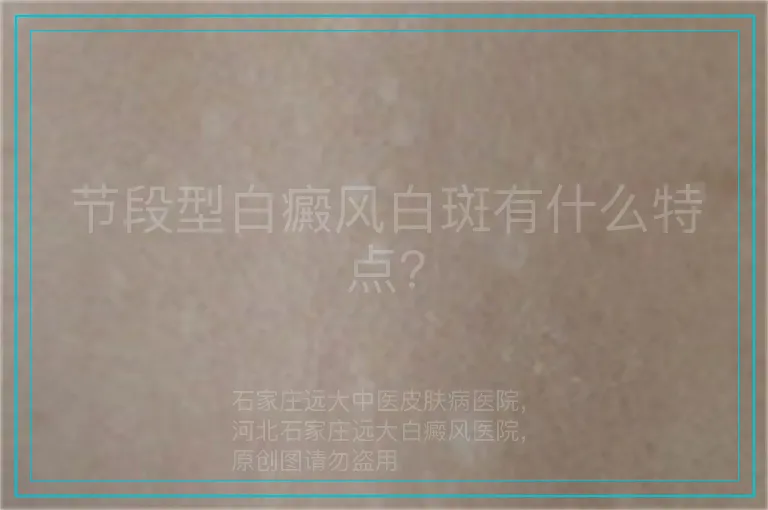 节段型白癜风白斑有什么特点?