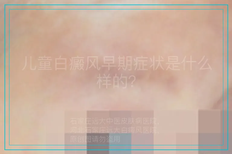儿童白癜风早期症状是什么样的？