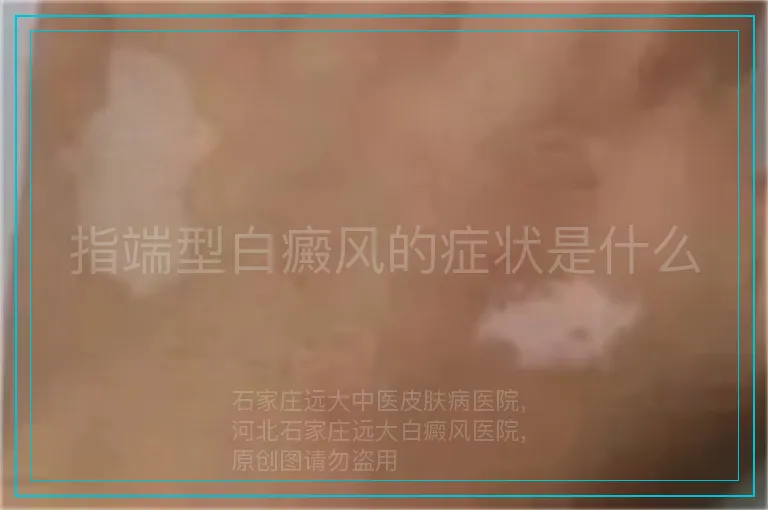 指端型白癜风的症状是什么