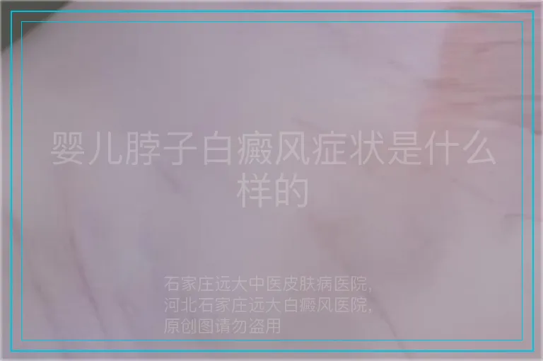 婴儿脖子白癜风症状是什么样的