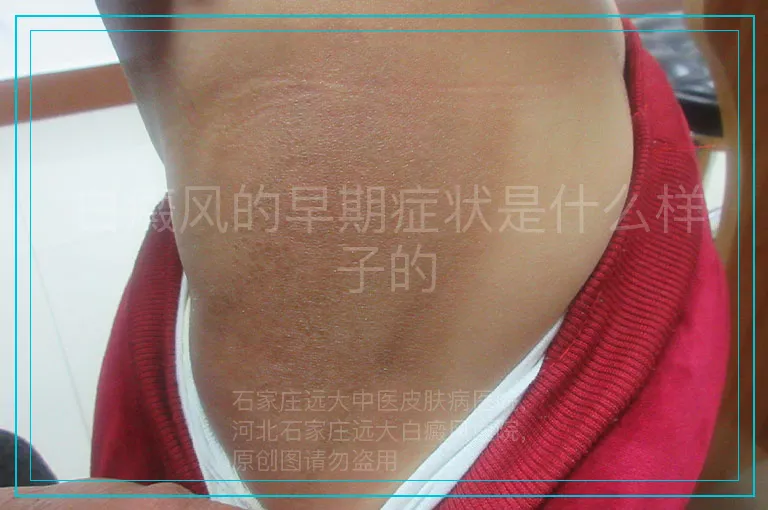 白癜风的早期症状是什么样子的