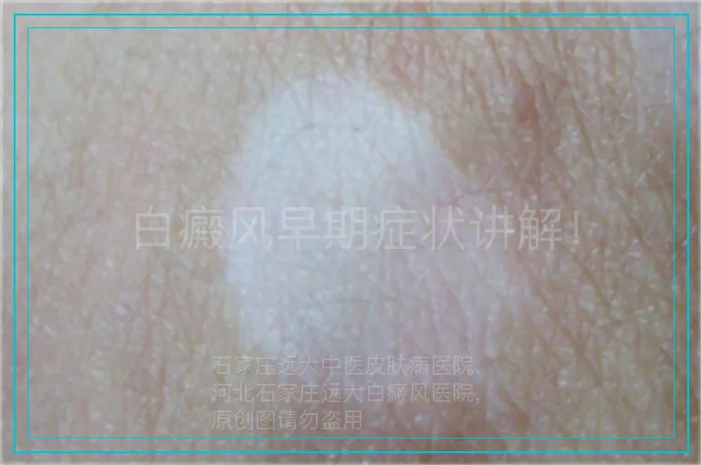 白癜风早期症状讲解！