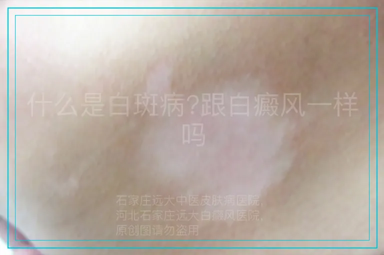 什么是白斑病?跟白癜风一样吗