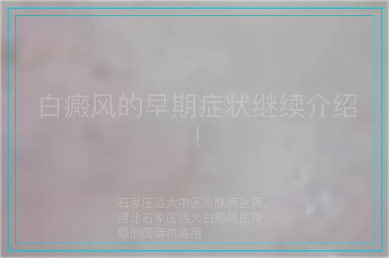白癜风的早期症状继续介绍!