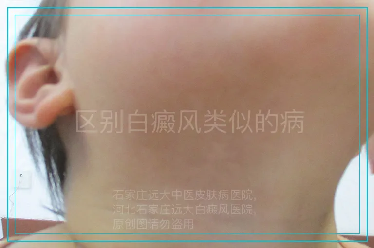 区别白癜风类似的病