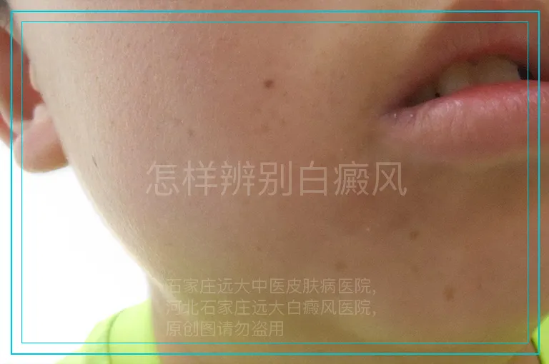 怎样辨别白癜风