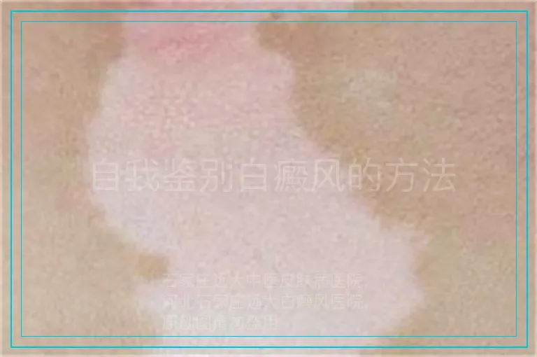 自我鉴别白癜风的方法