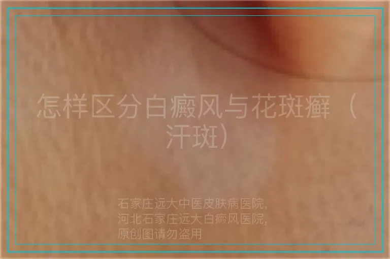 怎样区分白癜风与花斑癣（汗斑）