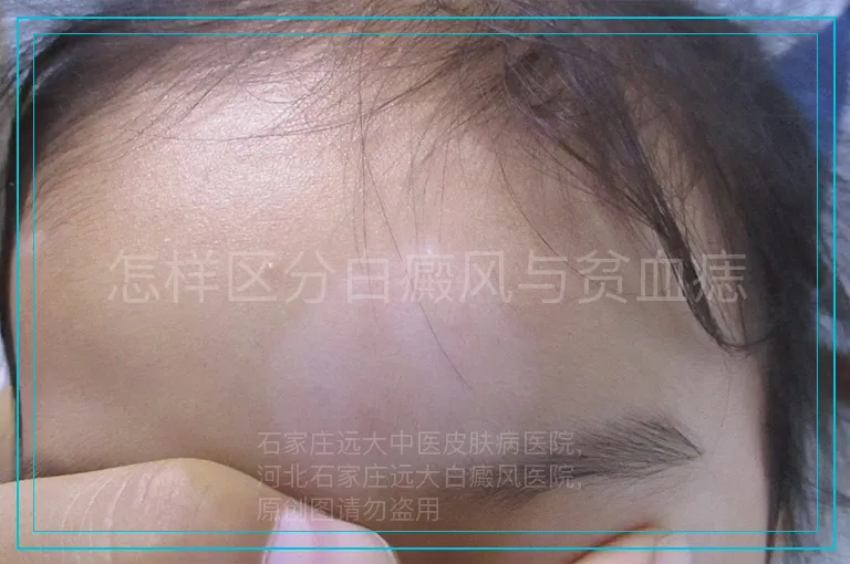 怎样区分白癜风与贫血痣