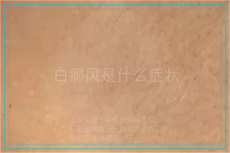 白癫风是什么症状