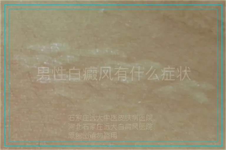 男性白癜风有什么症状