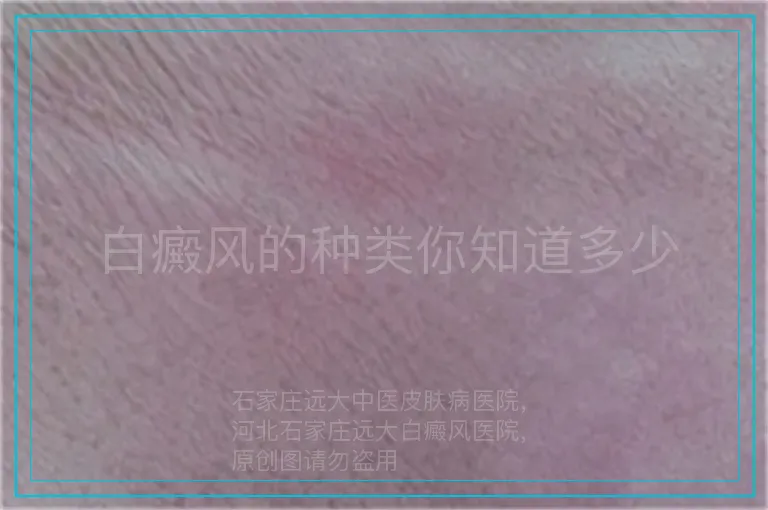 白癜风的种类你知道多少