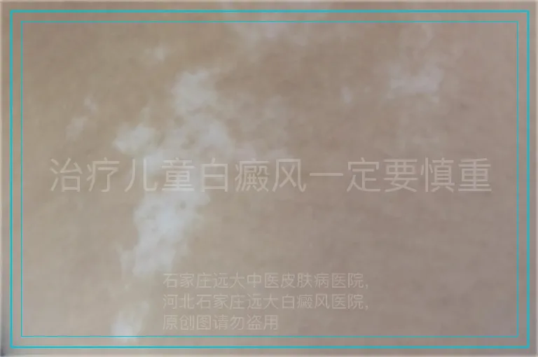 治疗儿童白癜风一定要慎重