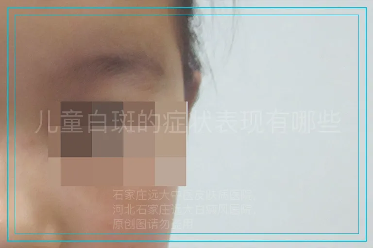 儿童白斑的症状表现有哪些