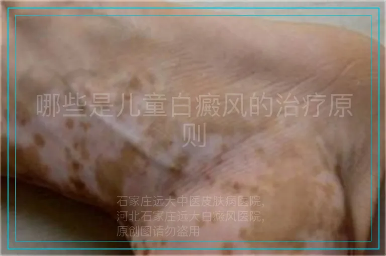 哪些是儿童白癜风的治疗原则