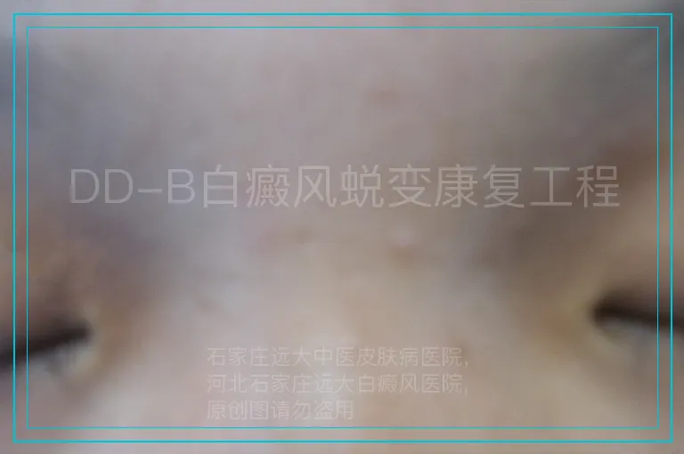 DD-B白癜风蜕变康复工程