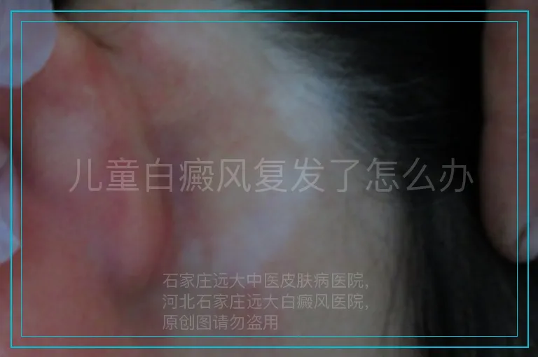 儿童白癜风复发了怎么办