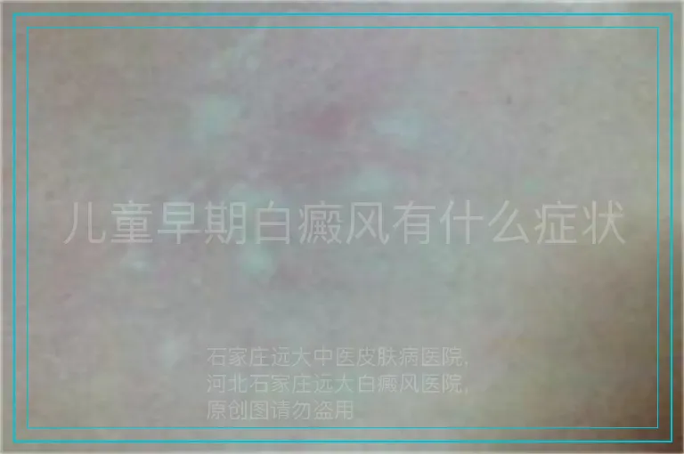 儿童早期白癜风有什么症状