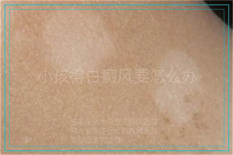 小孩得白癜风要怎么办