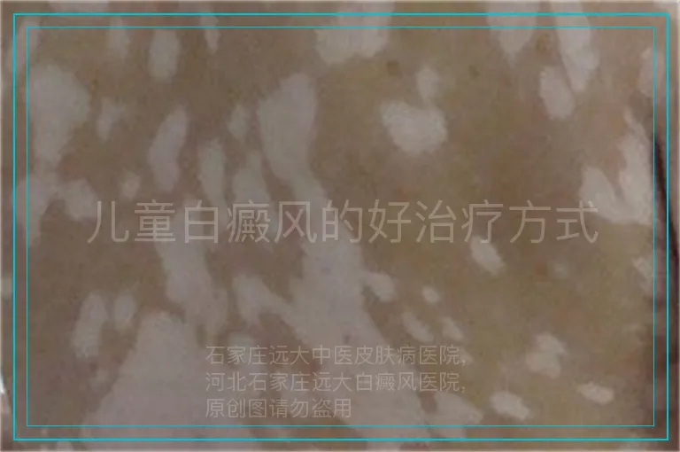 儿童白癜风的好治疗方式