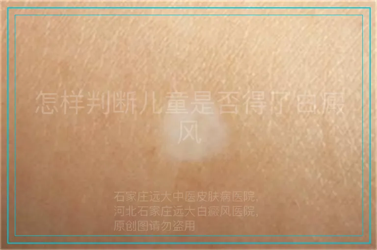 怎样判断儿童是否得了白癜风