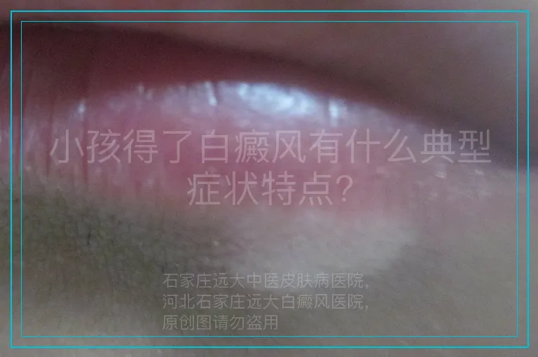 小孩得了白癜风有什么典型症状特点?