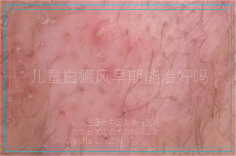 儿童白癜风早期能治好吗